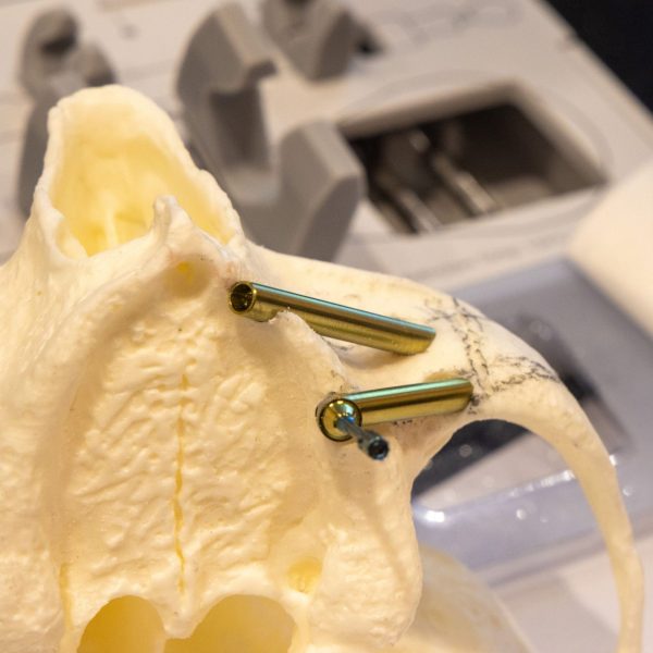 A hands-on training model with two zygomatic implants