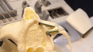 A hands-on model with two zygomatic implants