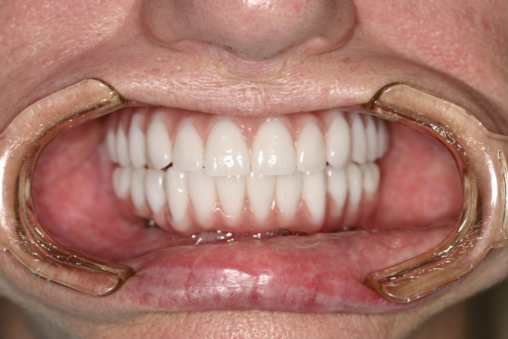 Picture of teeth after all-on-4 TeethXpress procedure